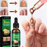 Nail Fungus Treatment
