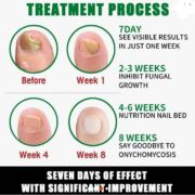 Nail Fungus Treatment