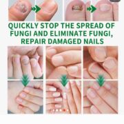 Nail Fungus Treatment