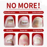 Nail Fungus Treatment